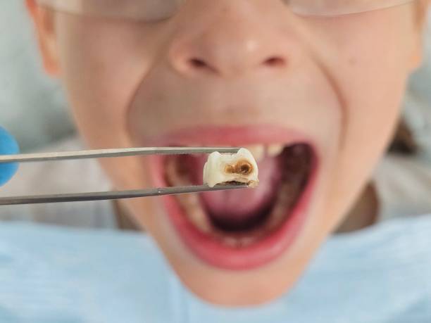 Best Emergency Tooth Extraction in Bloomingdale, NJ